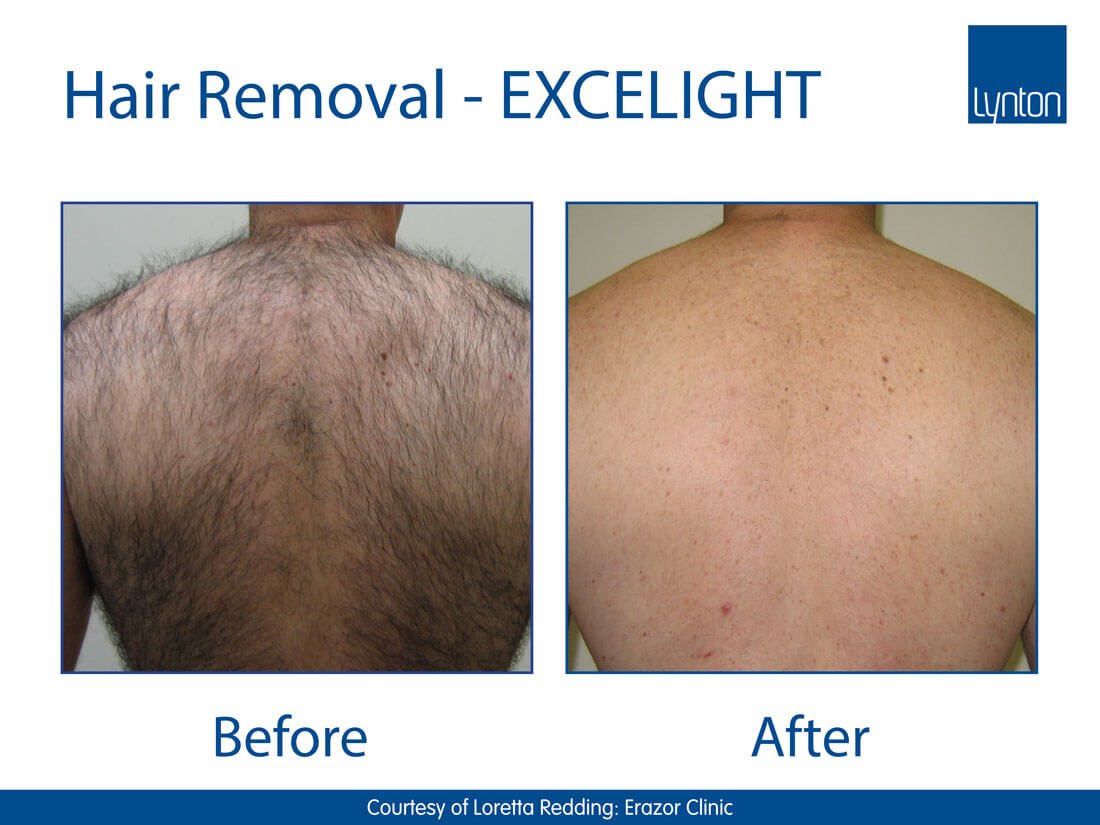 IPL Laser Hair Removal Preston Before and After